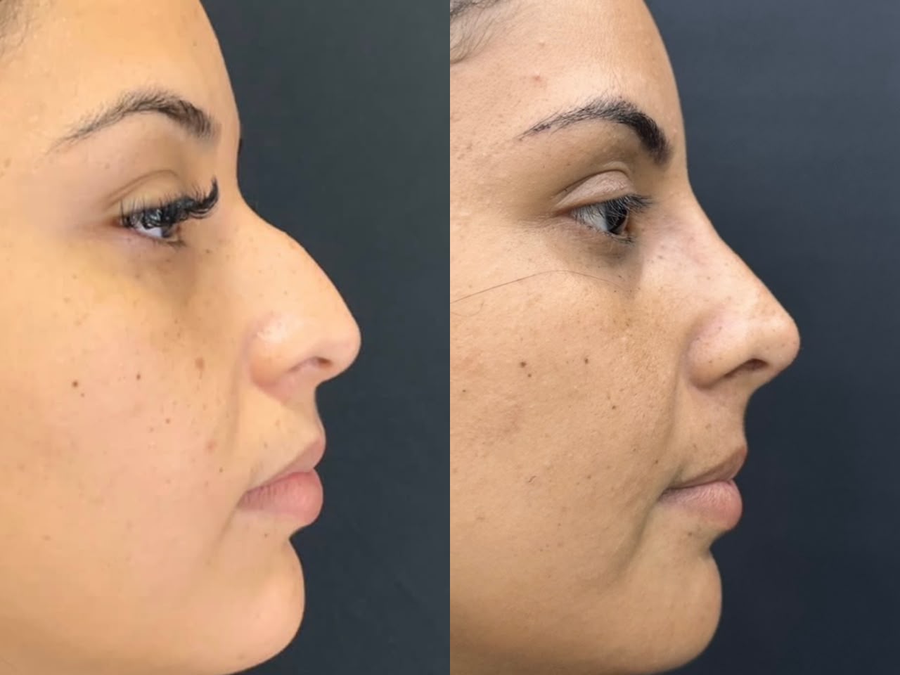 Rinomodelacao RP - Harmonizacao Nasal sem Cirurgia